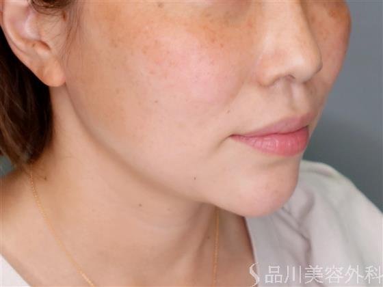 症例NO.51241のBEFORE写真
