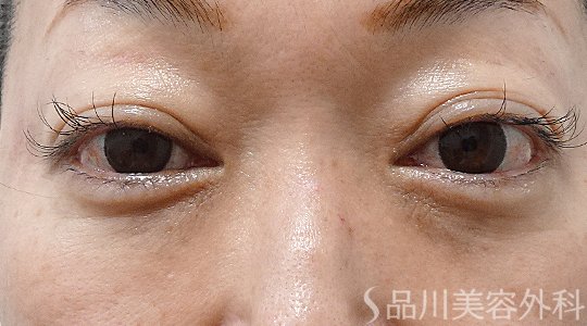 症例NO.62928のAFTER写真