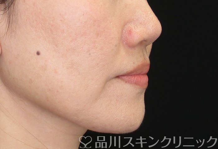 症例NO.74480のBEFORE写真