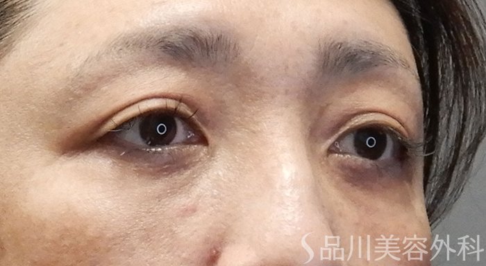 症例NO.70095のAFTER写真