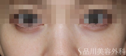 症例NO.70530のBEFORE写真