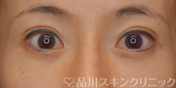 症例NO.73839のAFTER写真