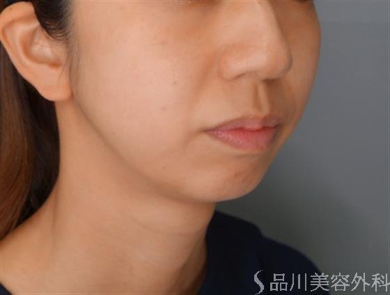 症例NO.54720のBEFORE写真