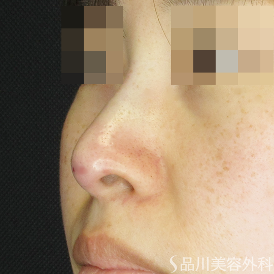 症例NO.70243のAFTER写真