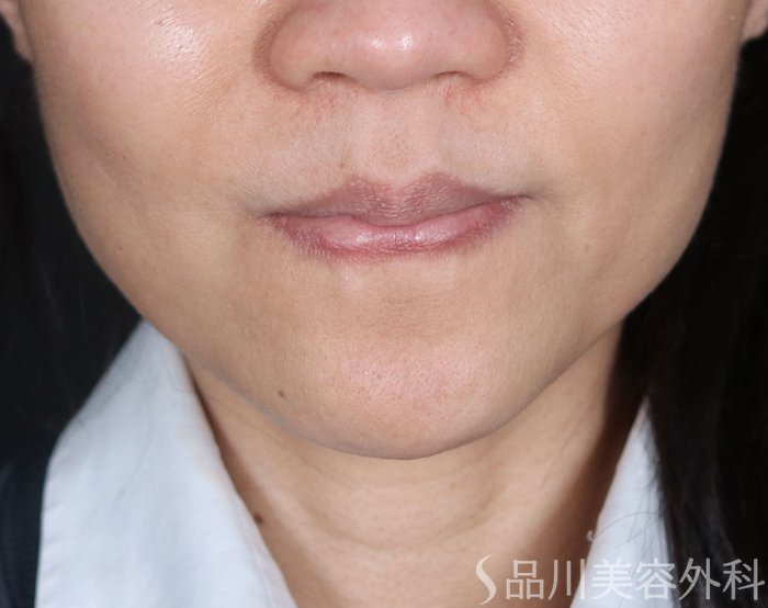 症例NO.72976のBEFORE写真