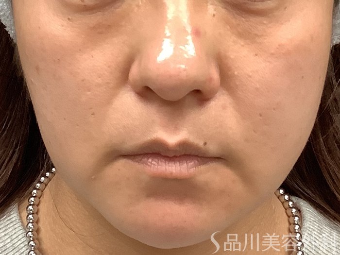 症例NO.67793のBEFORE写真