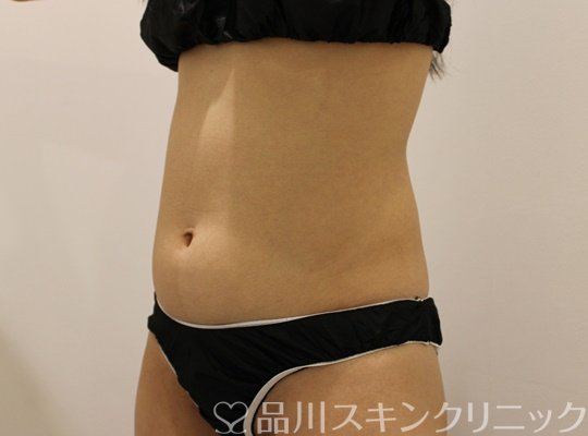 症例NO.75018のBEFORE写真