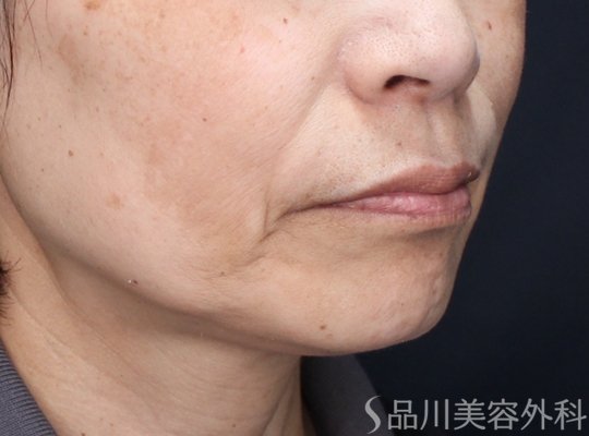 症例NO.74169のBEFORE写真