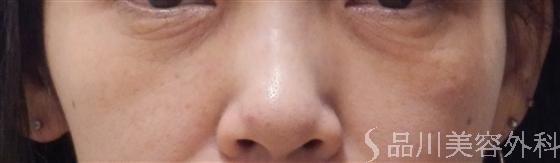 症例NO.13800のBEFORE写真