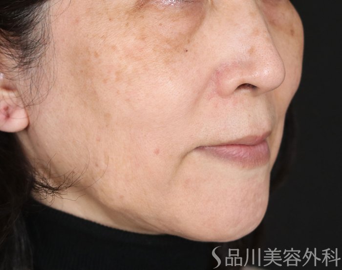 症例NO.72914のBEFORE写真