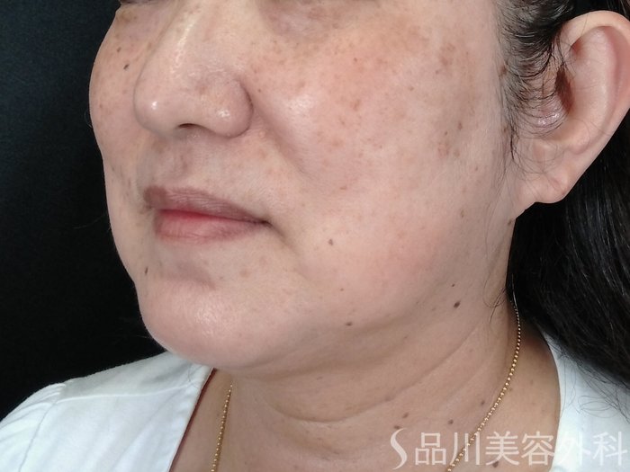 症例NO.70838のBEFORE写真