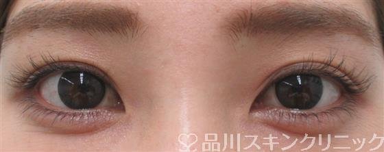 症例NO.27432のBEFORE写真