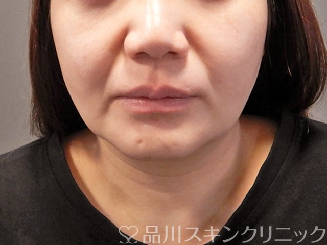 症例NO.69214のBEFORE写真