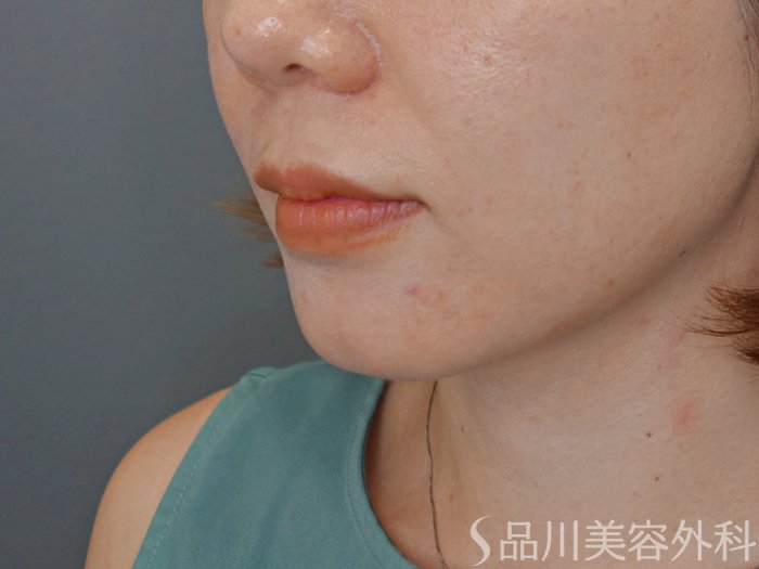 症例NO.71838のBEFORE写真