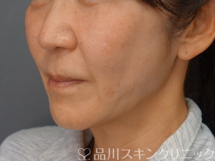 症例NO.74314のAFTER写真
