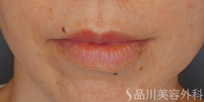 症例NO.71645のBEFORE写真