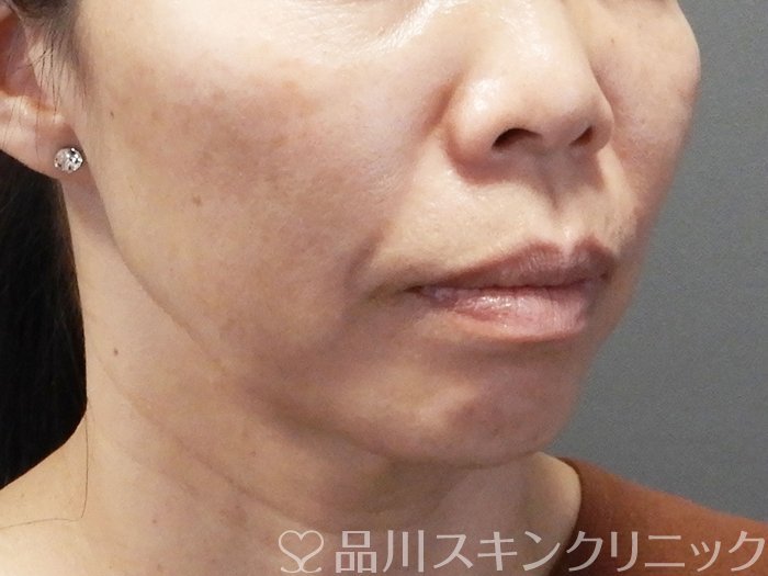 症例NO.73479のBEFORE写真