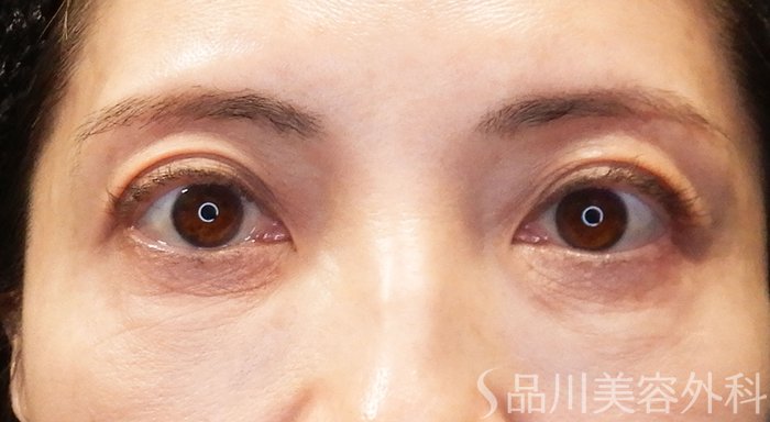 症例NO.69496のAFTER写真