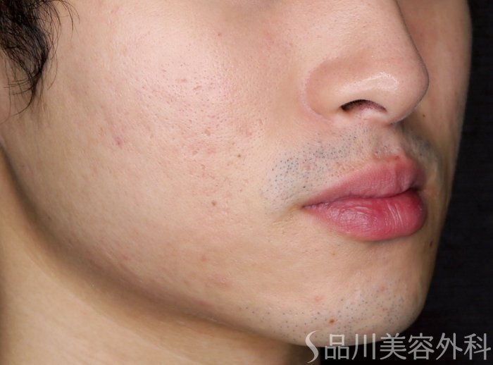 症例NO.75313のAFTER写真