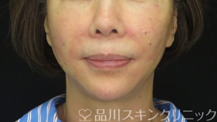 症例NO.72272のAFTER写真