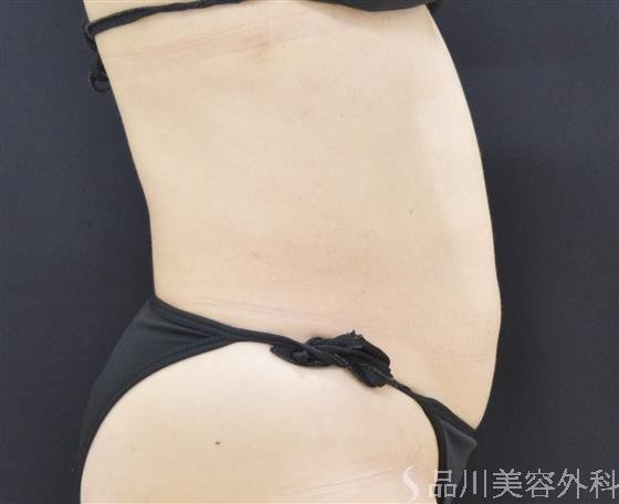 症例NO.50006のAFTER写真