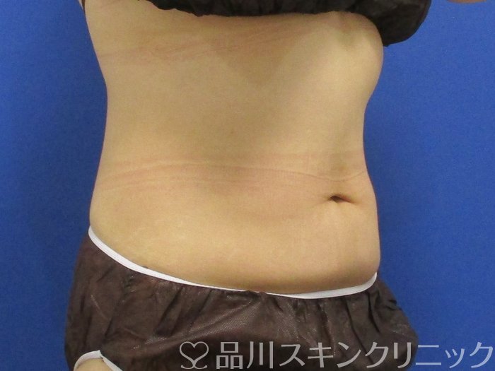 症例NO.70808のAFTER写真