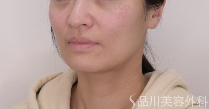 症例NO.69365のBEFORE写真