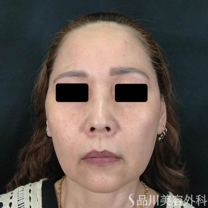 症例NO.72665のBEFORE写真