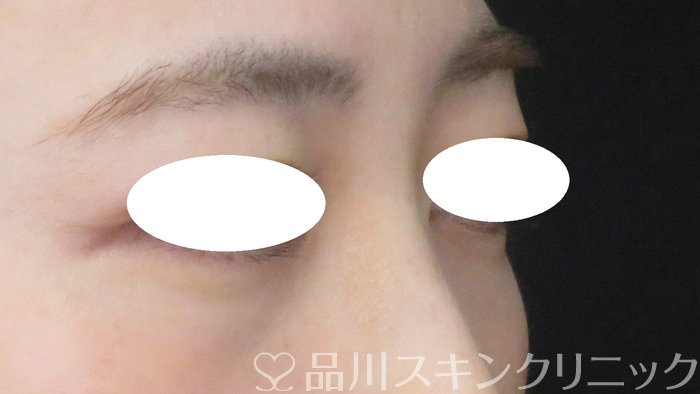 症例NO.70430のBEFORE写真