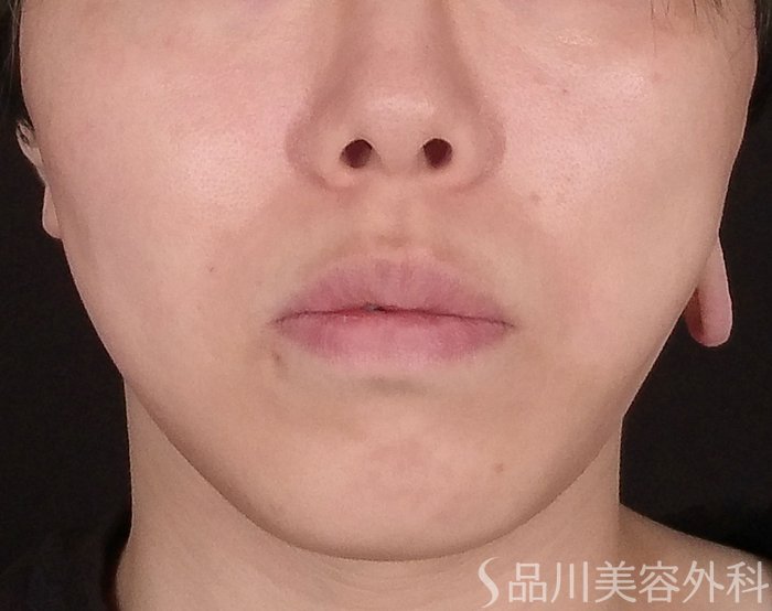 症例NO.70548のAFTER写真