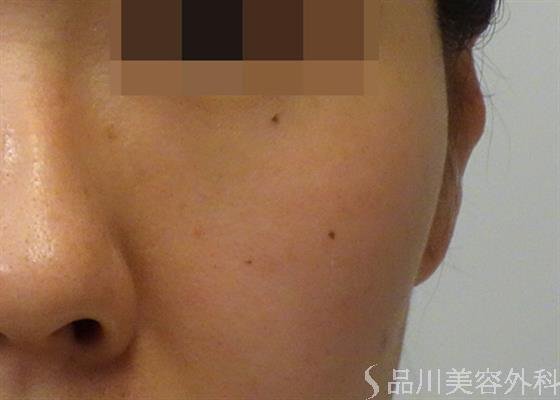 症例NO.47416のAFTER写真