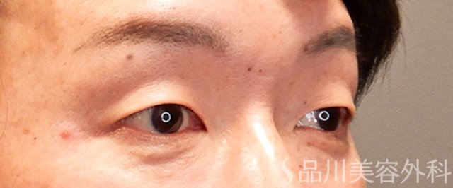 症例NO.69298のBEFORE写真