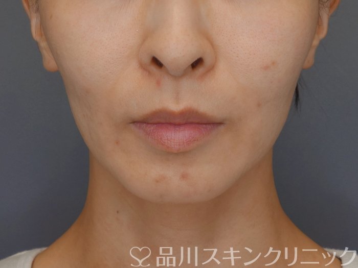 症例NO.71717のBEFORE写真