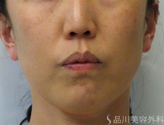 症例NO.41206のAFTER写真