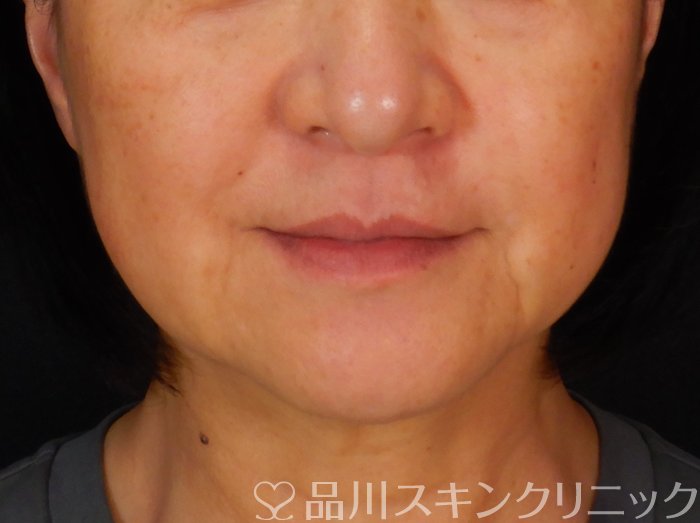 症例NO.66579のBEFORE写真