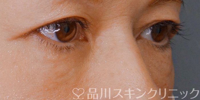症例NO.71191のAFTER写真