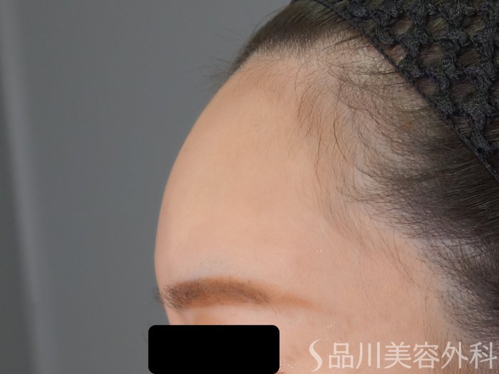 症例NO.71126のAFTER写真