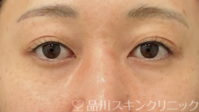 症例NO.74381のBEFORE写真