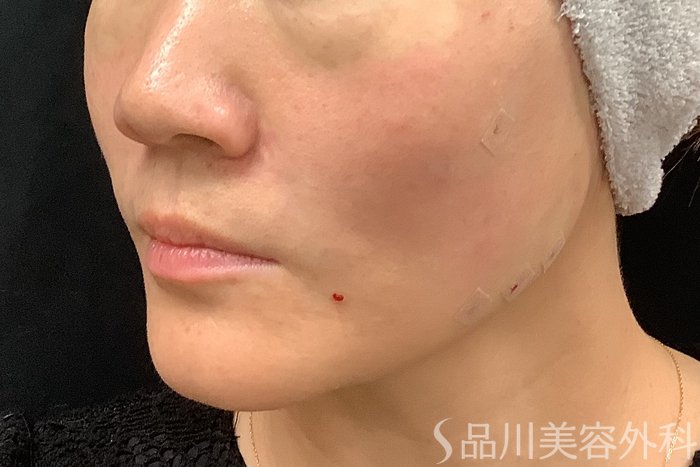症例NO.66055のAFTER写真