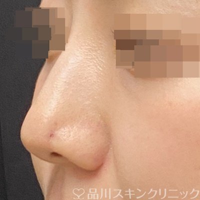 症例NO.70035のAFTER写真