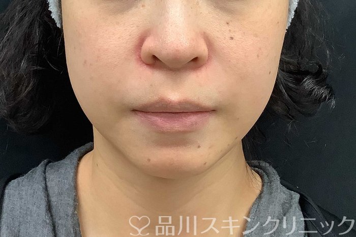 症例NO.69519のBEFORE写真