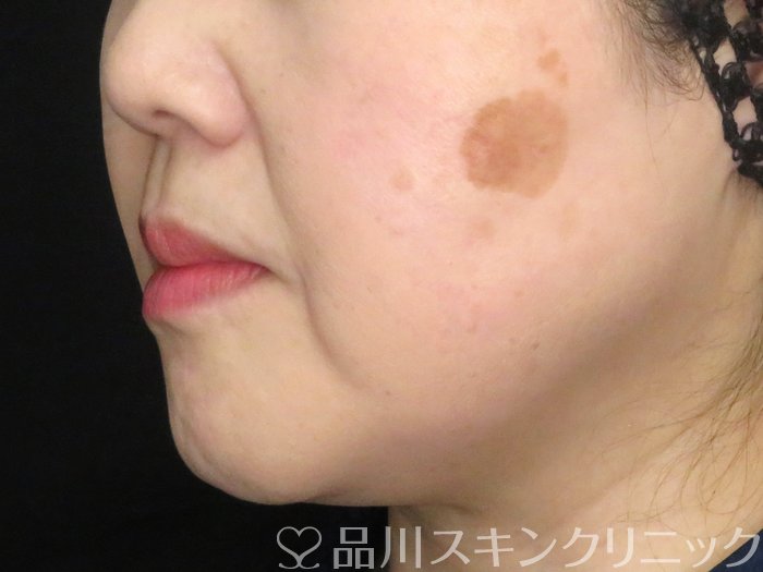 症例NO.67980のBEFORE写真