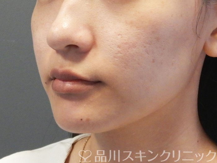 症例NO.73327のBEFORE写真