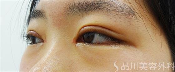 症例NO.34412のAFTER写真