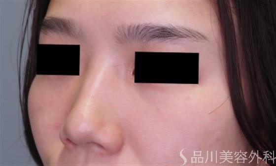 症例NO.48517のBEFORE写真