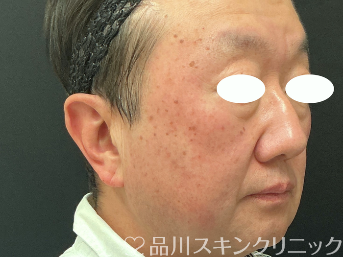 症例NO.74029のBEFORE写真