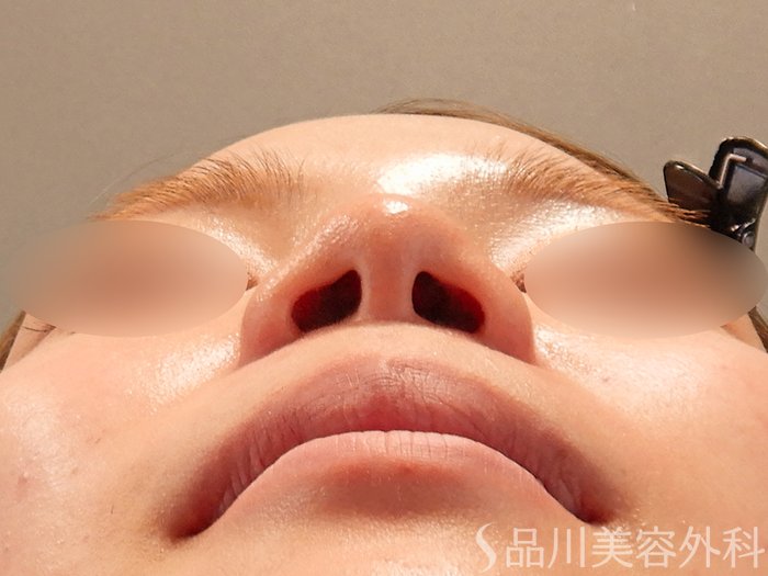 症例NO.70794のBEFORE写真