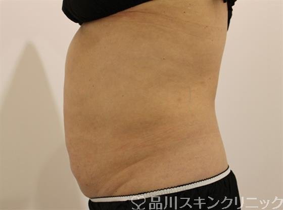 症例NO.46318のBEFORE写真
