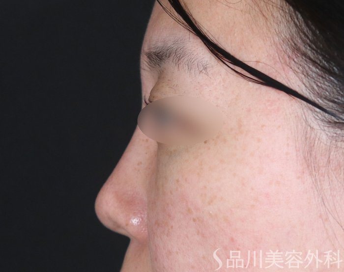 症例NO.73783のBEFORE写真