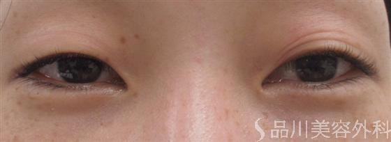 症例NO.17183のBEFORE写真